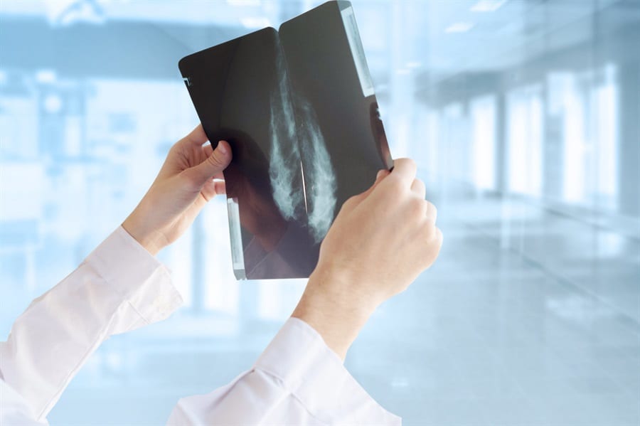 Cáncer de mama: en miles de casos, un test permitirá evitar la quimioterapia